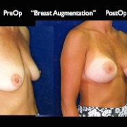 Breast-Aug2.019