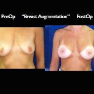 Breast-Aug2.020