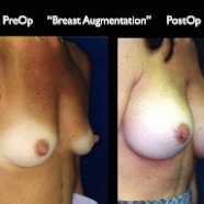 Breast-Aug2.021