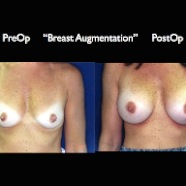 Breast-Aug2.022