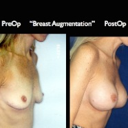 Breast-Aug2.023