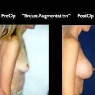 Breast-Aug2.025