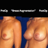 Breast-Aug2.026