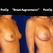 Breast-Aug2.027