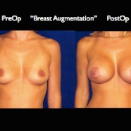 Breast-Aug2.028