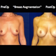 Breast-Aug2.029