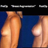 Breast-Aug2.030