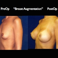 Breast-Aug2.031