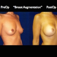 Breast-Aug2.033