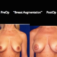 Breast-Aug2.034