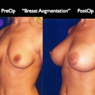 Breast-Aug2.035