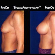 Breast-Aug2.036