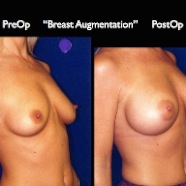 Breast-Aug2.037