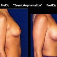 Breast-Aug2.038