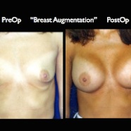 Breast-Aug2.039