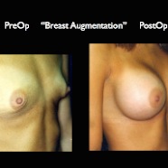 Breast-Aug2.040