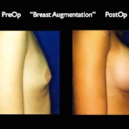 Breast-Aug2.041