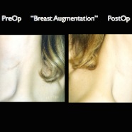 Breast-Aug2.042