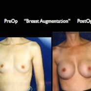 Breast-Aug2.043