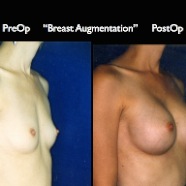 Breast-Aug2.044