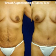 TummyTuck.022