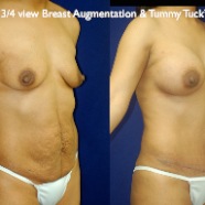 TummyTuck.023